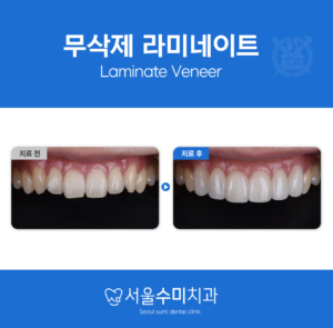무삭제 라미네이트
