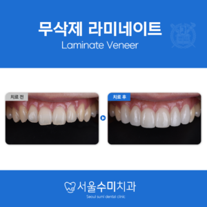무삭제 라미네이트