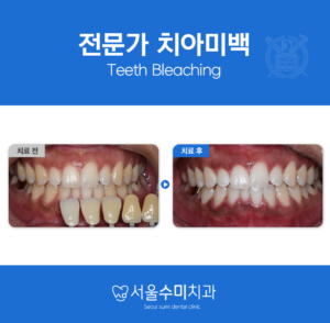 회현역치과전문가치아미백