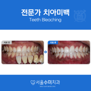 회현역치과전문가치아미백