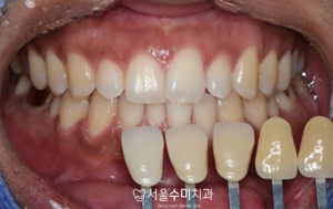 회현역치과치료전