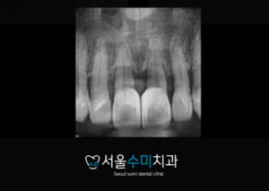 치간이개증례사진2