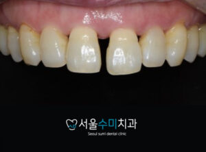 치간이개증례사진