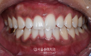 회현역치과치료후