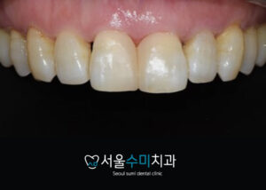 회현역치과 치간이개증례사진1
